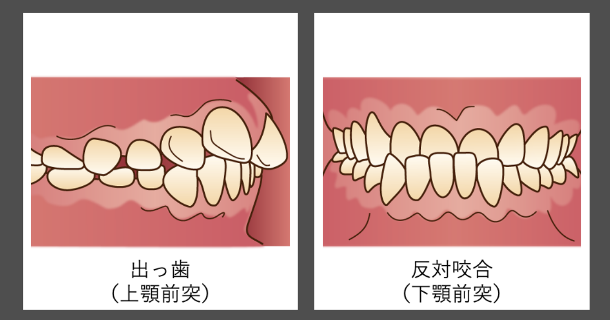 歯科矯正に抜歯は必要 抜歯が必要なパターンと治療の流れを解説 Hanaravi歯科矯正blog