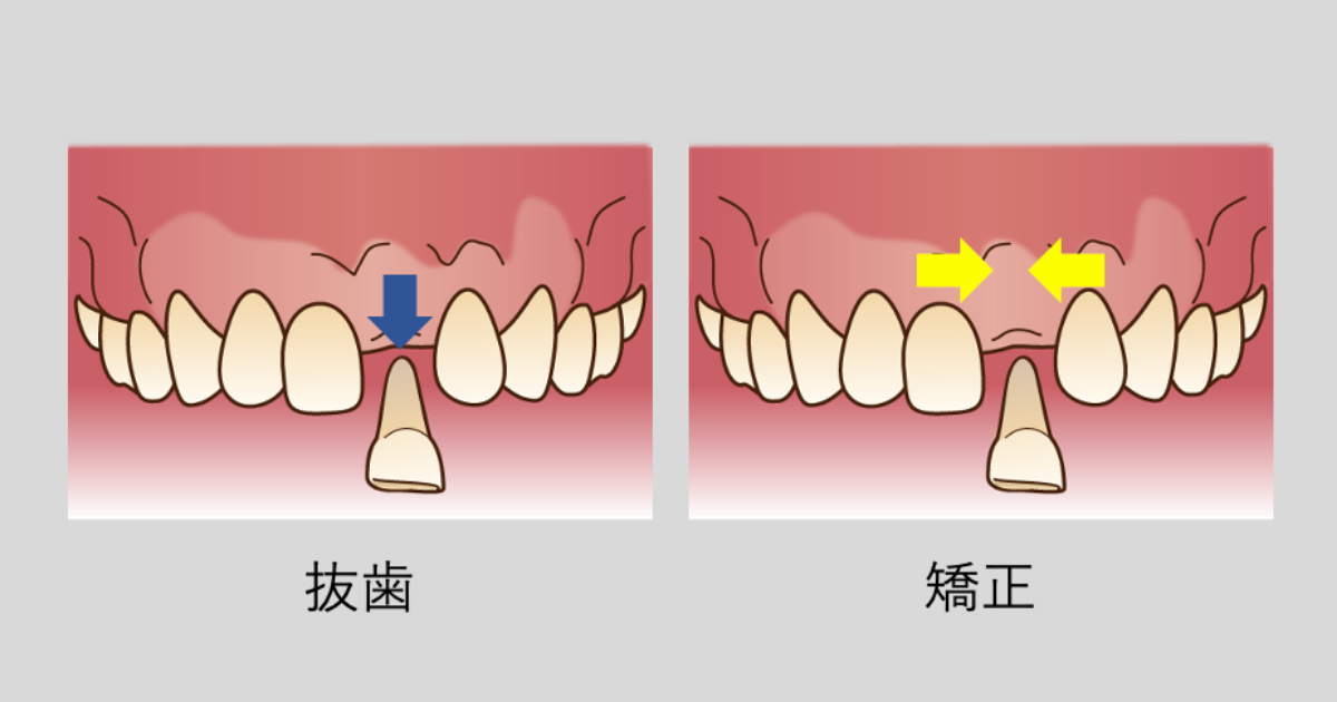 歯科矯正に抜歯は必要 抜歯が必要なパターンと治療の流れを解説 Hanaravi歯科矯正blog