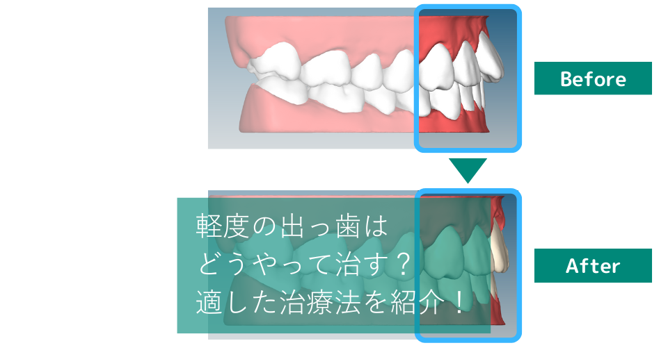 軽度の出っ歯の基準・治し方は？費用感や自力で治す方法についても解説 | hanaravi歯科矯正blog