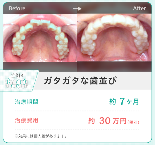 マウスピース矯正の費用相場は？マウスピース矯正の種類を比較