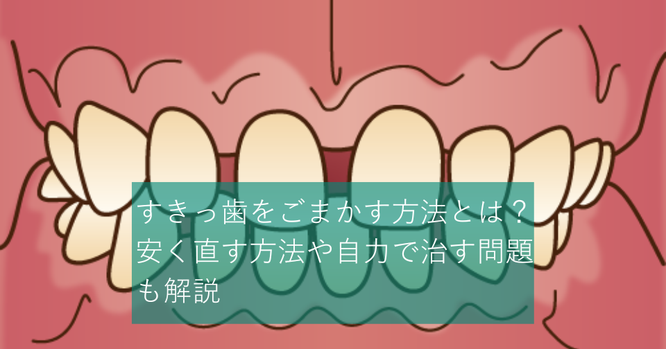 すきっ歯をごまかす方法とは？安く直す方法や自力で治す問題も解説 | hanaravi歯科矯正blog