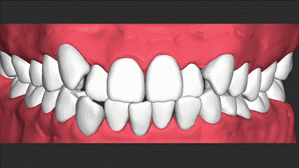 八重歯の矯正シミュレーション画像