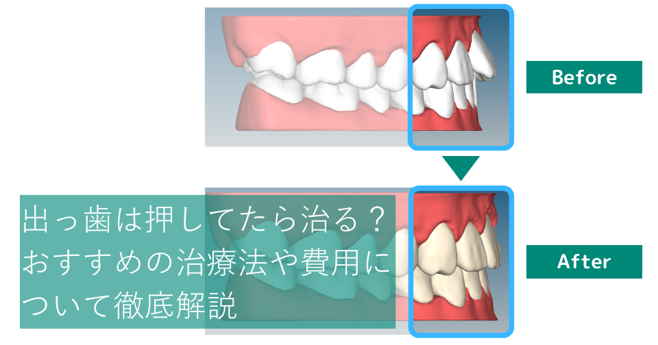 出っ歯は押してたら治る？そのリスクや治療法、費用について徹底解説 | hanaravi歯科矯正blog