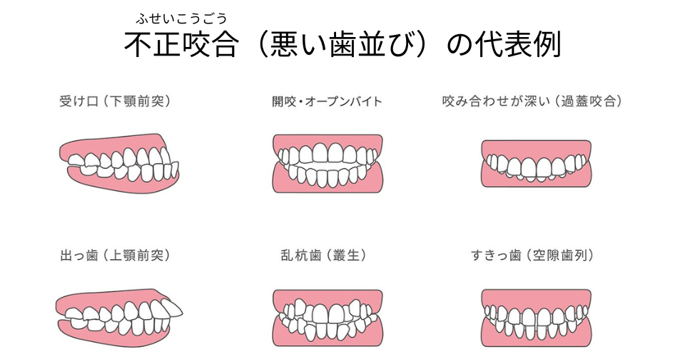 不正咬合の代表例