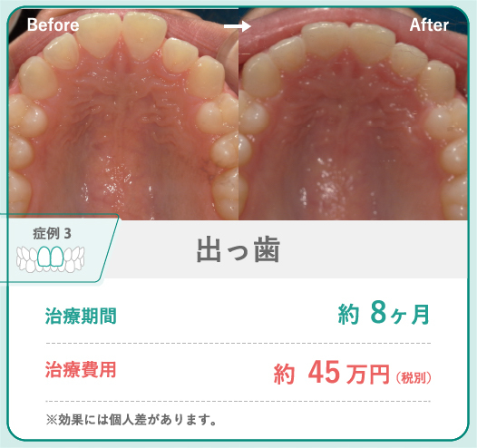 出っ歯の症例