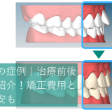 歯列矯正の症例｜治療前後の写真を紹介！矯正費用と期間の目安も