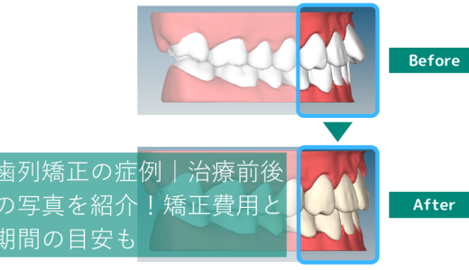 歯列矯正の症例｜治療前後の写真を紹介！矯正費用と期間の目安も