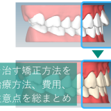 出っ歯を治す矯正方法を解説！治療方法、費用、期間、注意点を総まとめ