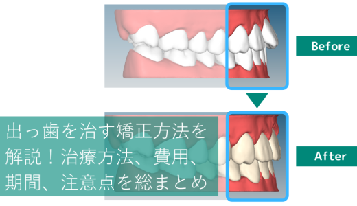 出っ歯を治す矯正方法を解説！治療方法、費用、期間、注意点を総まとめ