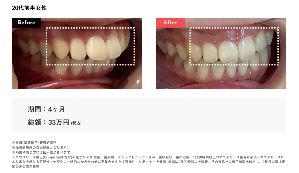 Oh my teeth出っ歯の症例1