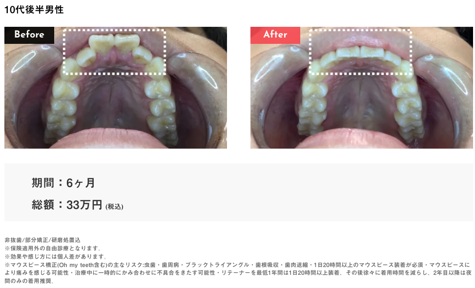 Oh my teeth出っ歯の症例3