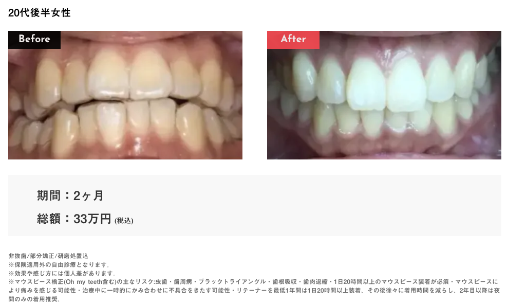 Oh my teeth叢生の症例1