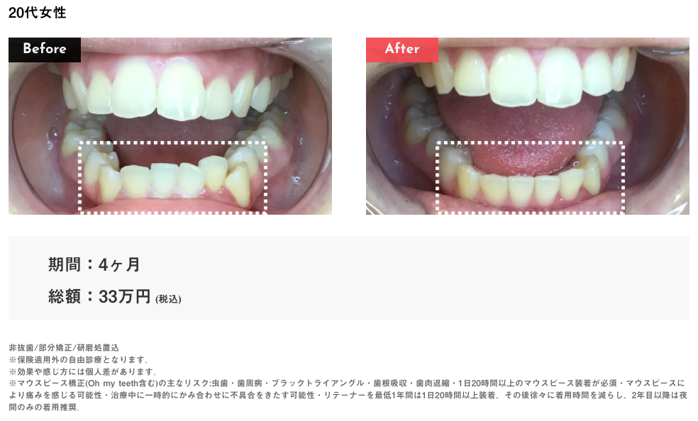 Oh my teeth叢生の症例2