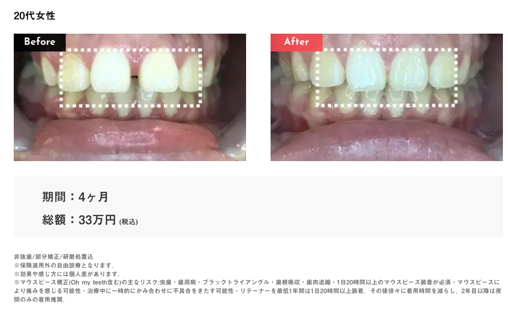 Oh my teethすきっ歯の症例2