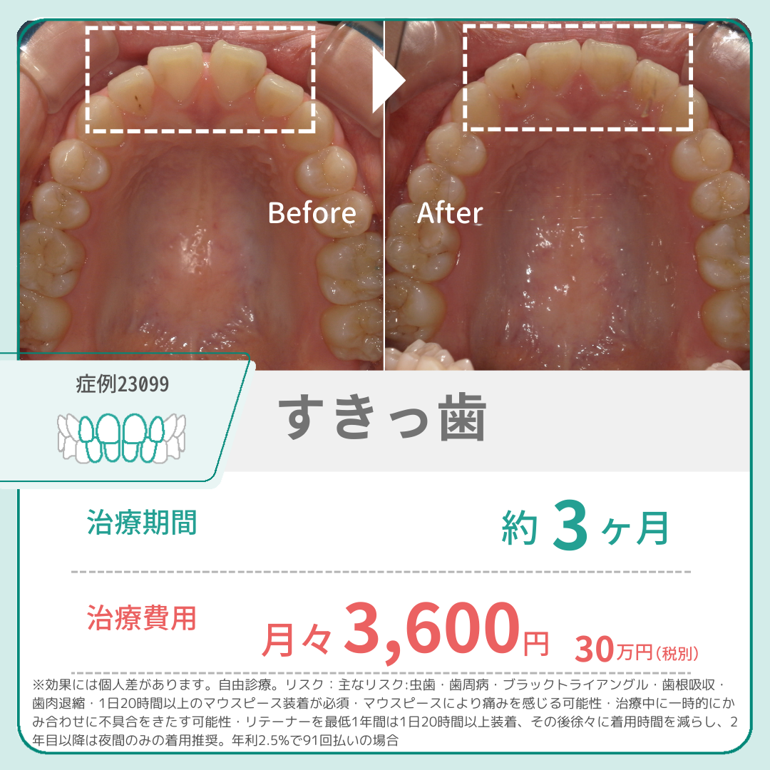 すきっ歯　症例　月々3,600円