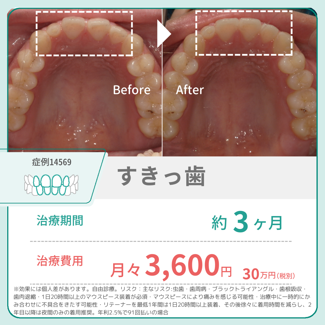 すきっ歯をごまかす方法とは？安く直す方法や自力で治す問題も解説 | hanaravi歯科矯正blog