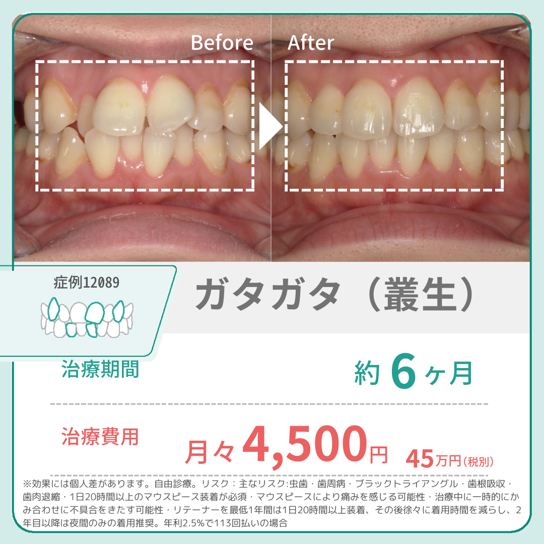 ガタツキ　ガタガタ　叢生　症例　月々4,500円